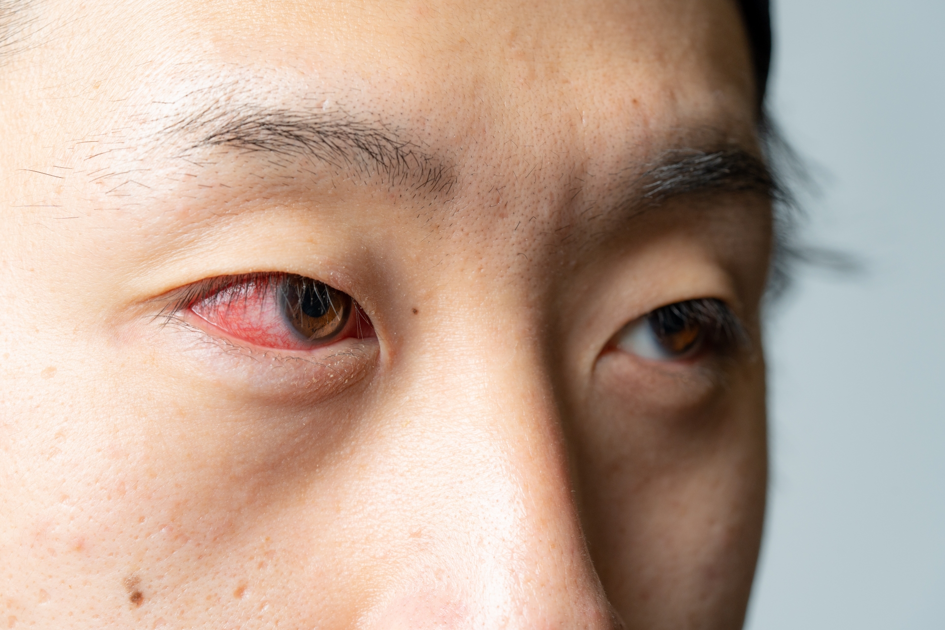 レーシック手術でおすすめの眼科
